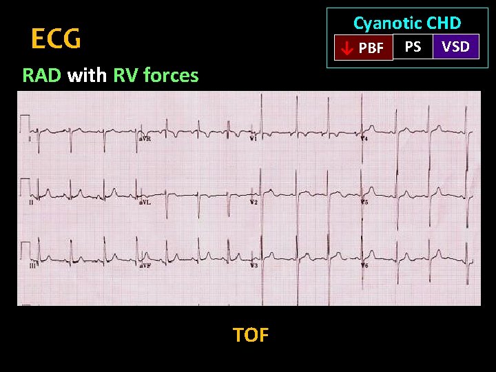 Cyanotic CHD ECG ↓ PBF RAD with RV forces TOF PS VSD 