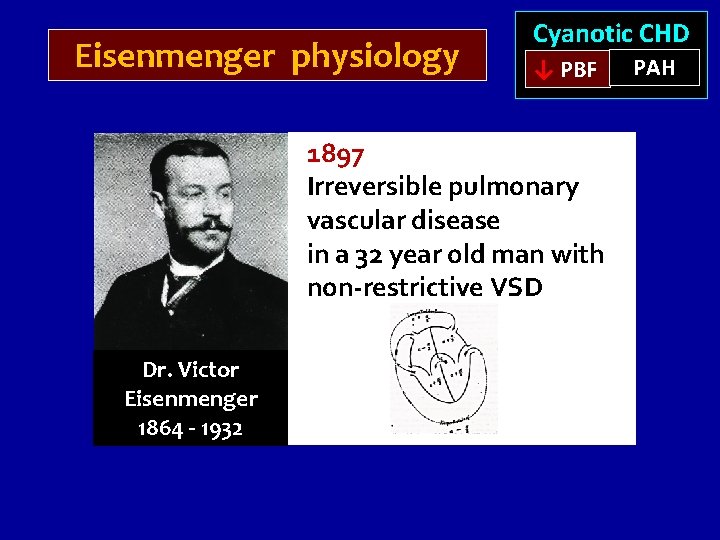 Eisenmenger physiology Cyanotic CHD ↓ PBF 1897 Irreversible pulmonary vascular disease in a 32