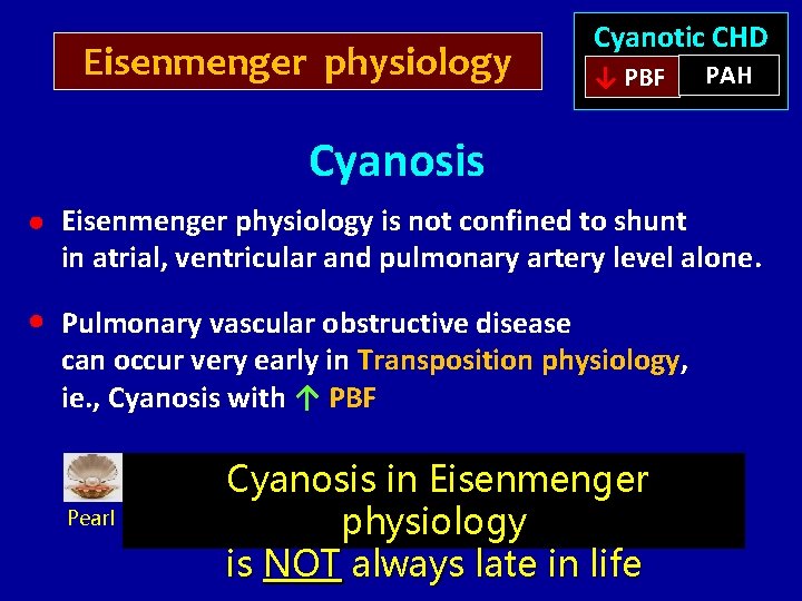 Eisenmenger physiology Cyanotic CHD ↓ PBF PAH Cyanosis Eisenmenger physiology is not confined to