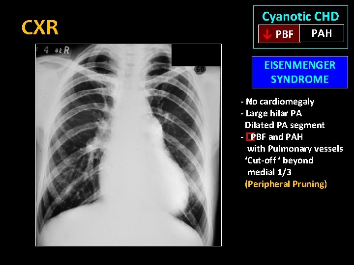 CXR Cyanotic CHD ↓ PBF PAH EISENMENGER SYNDROME - No cardiomegaly - Large hilar