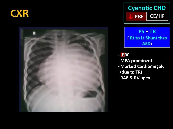 CXR Cyanotic CHD ↓ PBF CE/HF PS + TR ( Rt. to Lt Shunt