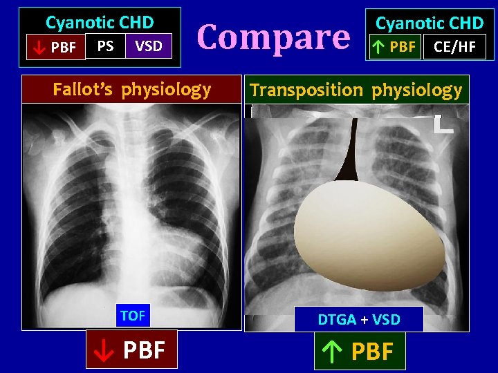 Cyanotic CHD ↓ PBF PS VSD Compare Cyanotic CHD ↑ PBF CE/HF Fallot’s physiology