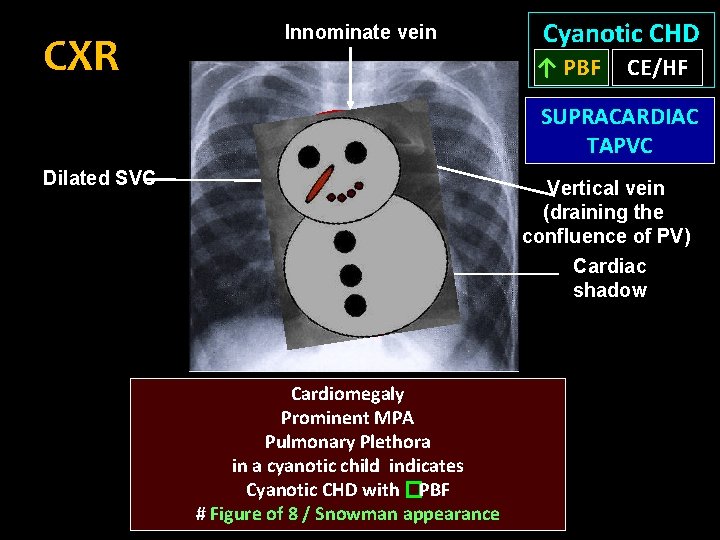 CXR Innominate vein Cyanotic CHD ↑ PBF CE/HF SUPRACARDIAC TAPVC Dilated SVC Vertical vein