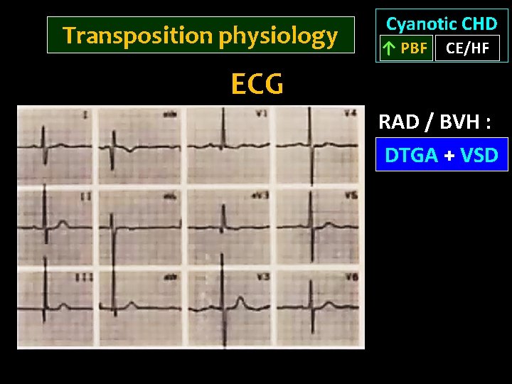 Transposition physiology Cyanotic CHD ↑ PBF CE/HF ECG RAD / BVH : DTGA +