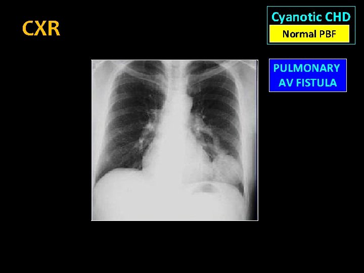CXR Cyanotic CHD Normal PBF PULMONARY AV FISTULA 
