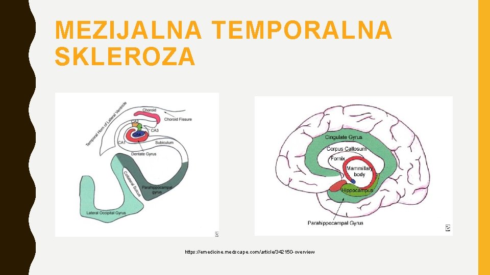 MEZIJALNA TEMPORALNA SKLEROZA https: //emedicine. medscape. com/article/342150 -overview 