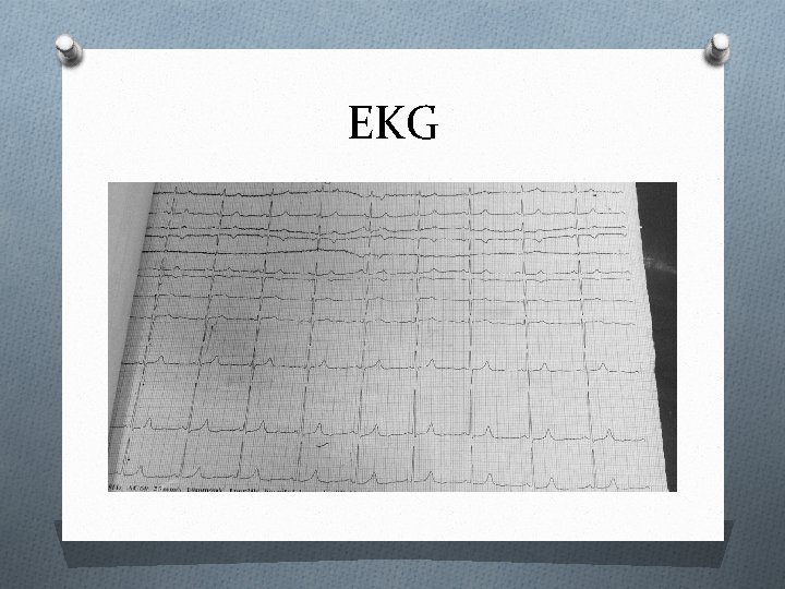 EKG 