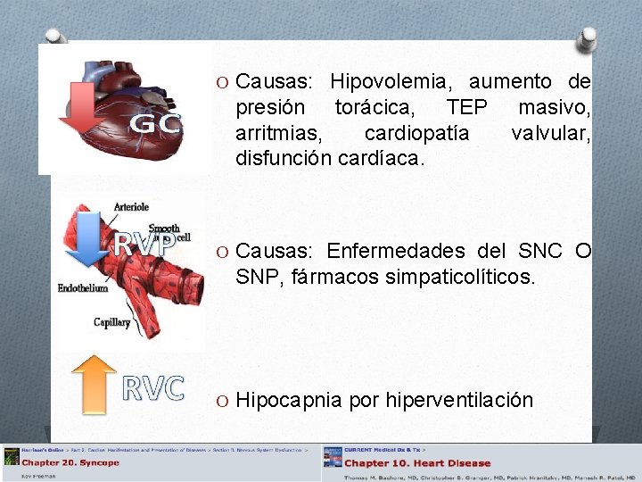 O Causas: Hipovolemia, aumento de presión torácica, TEP arritmias, cardiopatía disfunción cardíaca. masivo, valvular,