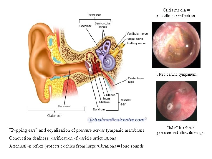 Otitis media = middle ear infection Fluid behind tympanum “Popping ears” and equalization of