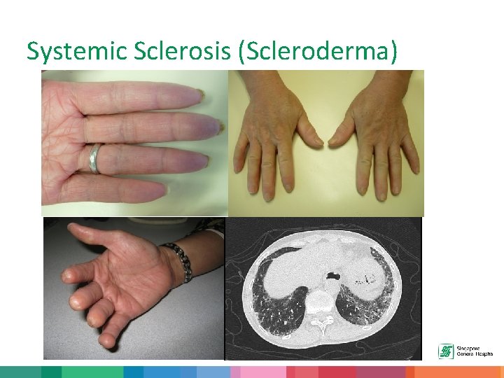 Systemic Sclerosis (Scleroderma) 
