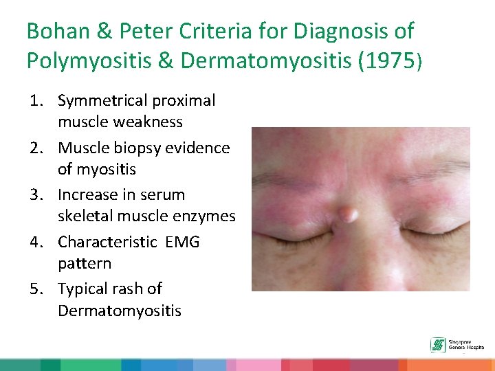 Bohan & Peter Criteria for Diagnosis of Polymyositis & Dermatomyositis (1975) 1. Symmetrical proximal