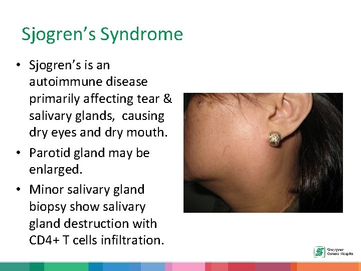 Sjogren’s Syndrome • Sjogren’s is an autoimmune disease primarily affecting tear & salivary glands,