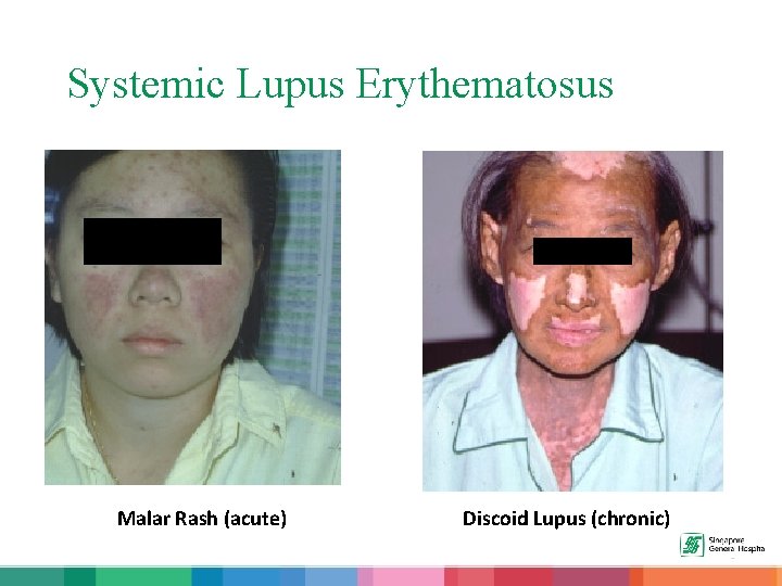 Systemic Lupus Erythematosus Malar Rash (acute) Discoid Lupus (chronic) 