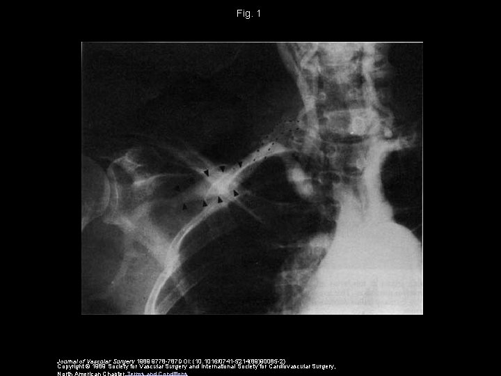 Fig. 1 Journal of Vascular Surgery 1989 9778 -787 DOI: (10. 1016/0741 -5214(89)90085 -2)