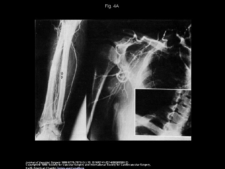Fig. 4 A Journal of Vascular Surgery 1989 9778 -787 DOI: (10. 1016/0741 -5214(89)90085