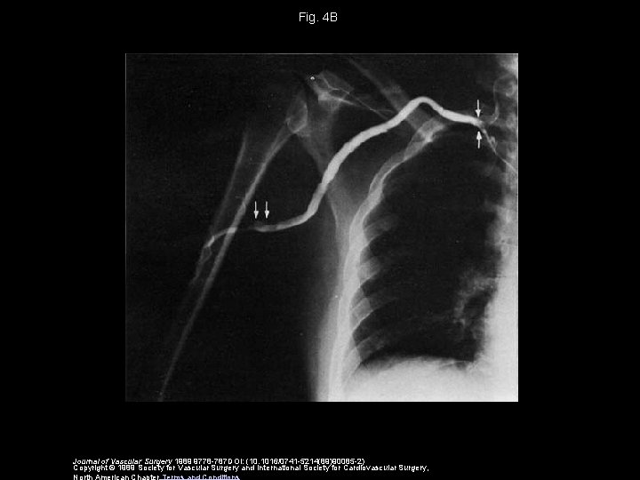 Fig. 4 B Journal of Vascular Surgery 1989 9778 -787 DOI: (10. 1016/0741 -5214(89)90085