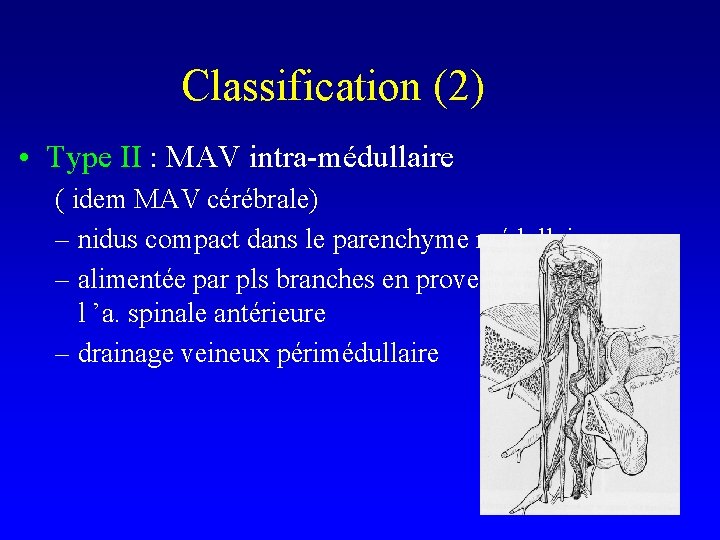 Classification (2) • Type II : MAV intra-médullaire ( idem MAV cérébrale) – nidus