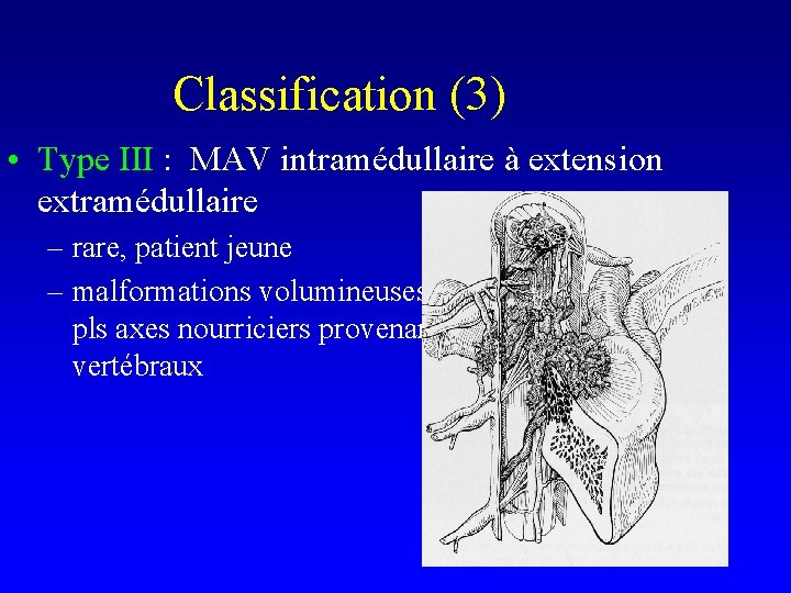 Classification (3) • Type III : MAV intramédullaire à extension extramédullaire – rare, patient