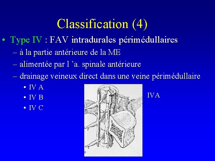 Classification (4) • Type IV : FAV intradurales périmédullaires – à la partie antérieure