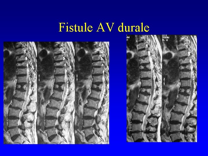 Fistule AV durale 