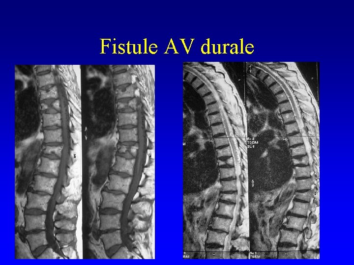 Fistule AV durale 