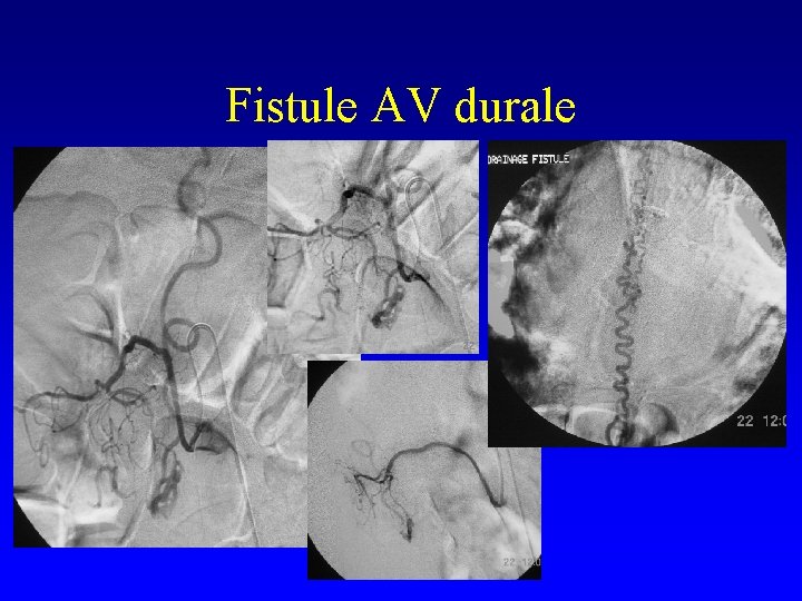 Fistule AV durale 