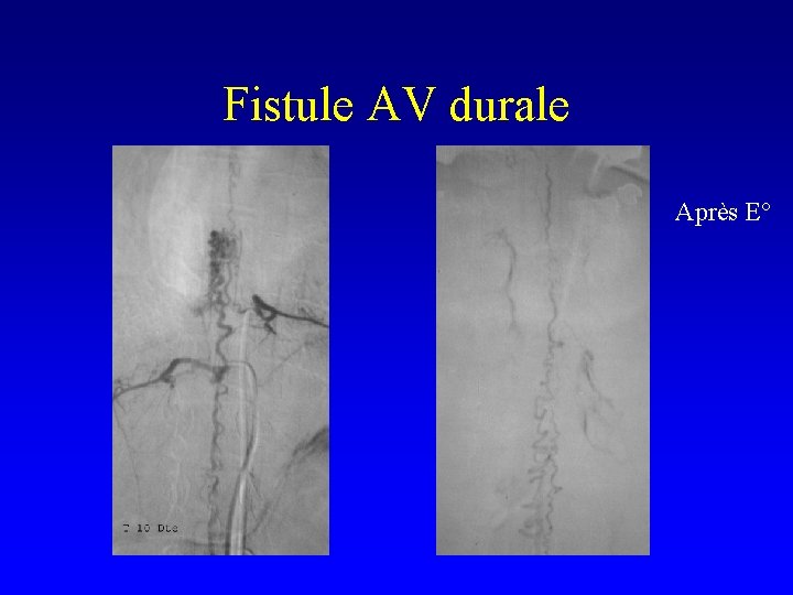 Fistule AV durale Après E° 