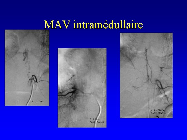 MAV intramédullaire 