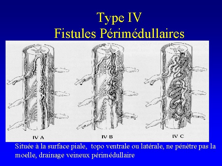 Type IV Fistules Périmédullaires IVA IVB IVC Située à la surface piale, topo ventrale