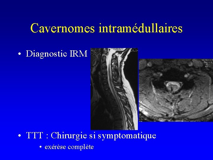 Cavernomes intramédullaires • Diagnostic IRM • TTT : Chirurgie si symptomatique • exérèse complète