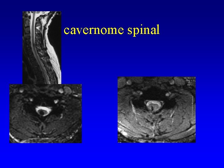 cavernome spinal 