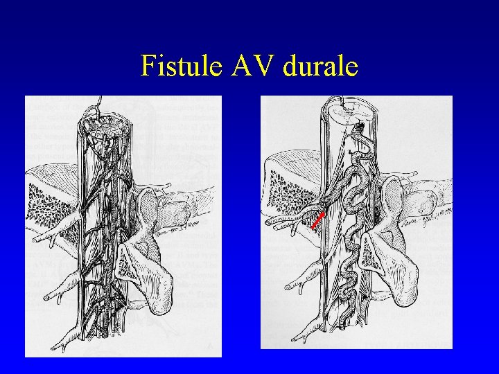 Fistule AV durale 