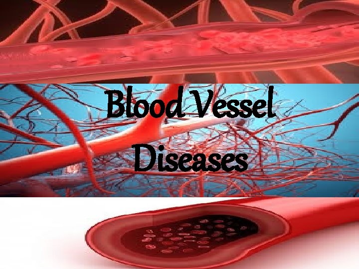 Blood Vessel Diseases Blood Vessel Diseases