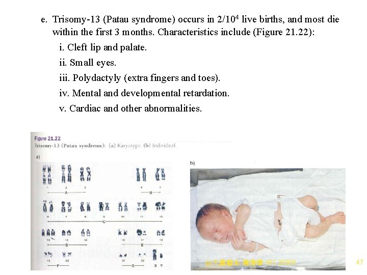 e. Trisomy-13 (Patau syndrome) occurs in 2/104 live births, and most die within the