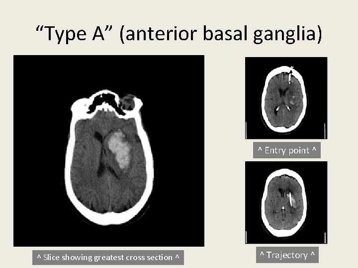 “Type A” (anterior basal ganglia) ^ Entry point ^ ^ Slice showing greatest cross