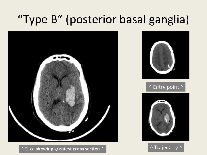 “Type B” (posterior basal ganglia) ^ Entry point ^ ^ Slice showing greatest cross