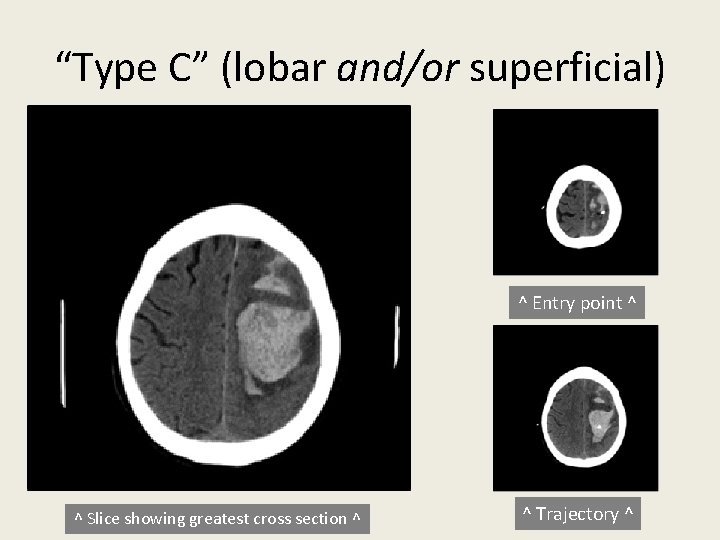“Type C” (lobar and/or superficial) ^ Entry point ^ ^ Slice showing greatest cross