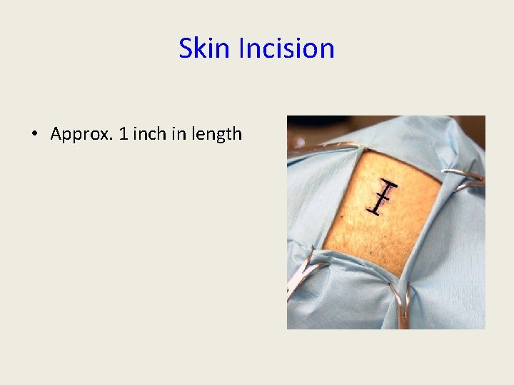 Skin Incision • Approx. 1 inch in length 