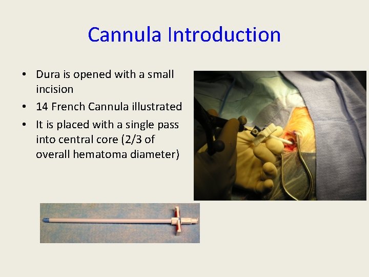 Cannula Introduction • Dura is opened with a small incision • 14 French Cannula