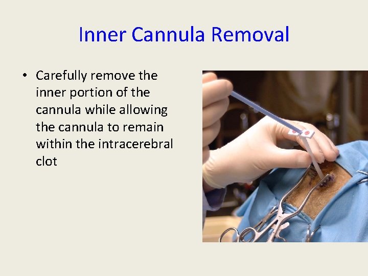 Inner Cannula Removal • Carefully remove the inner portion of the cannula while allowing