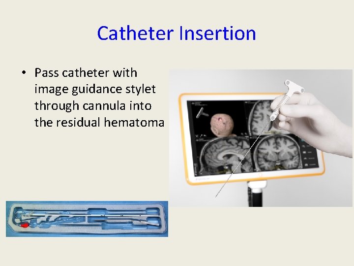 Catheter Insertion • Pass catheter with image guidance stylet through cannula into the residual