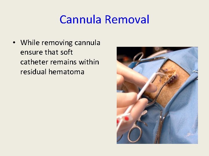 Cannula Removal • While removing cannula ensure that soft catheter remains within residual hematoma