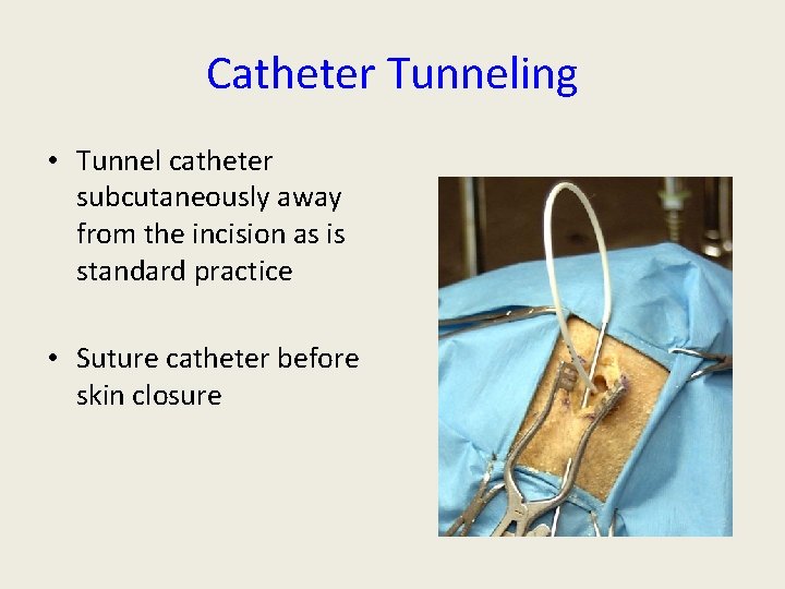 Catheter Tunneling • Tunnel catheter subcutaneously away from the incision as is standard practice