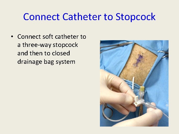 Connect Catheter to Stopcock • Connect soft catheter to a three-way stopcock and then