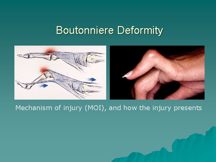 Boutonniere Deformity Mechanism of injury (MOI), and how the injury presents 