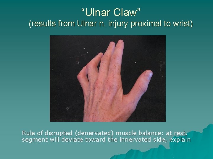 “Ulnar Claw” (results from Ulnar n. injury proximal to wrist) Rule of disrupted (denervated)