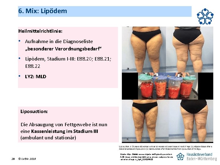 6. Mix: Lipödem Heilmittelrichtlinie: • Aufnahme in die Diagnoseliste „besonderer Verordnungsbedarf“ • Lipödem, Stadium