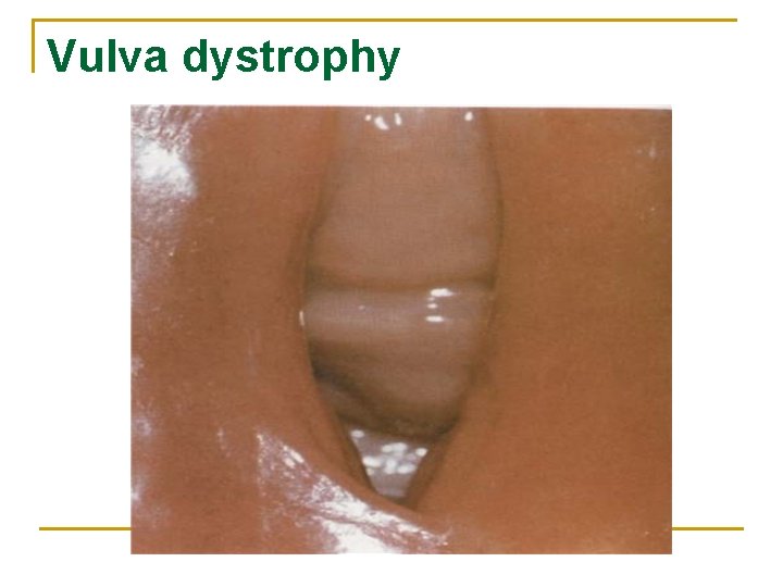 Vulva dystrophy 