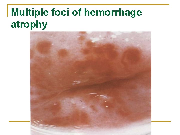 Multiple foci of hemorrhage atrophy 