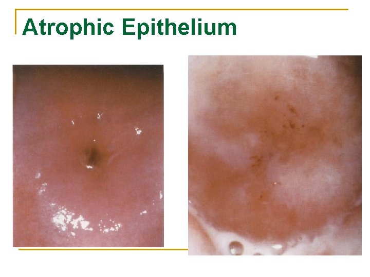 Atrophic Epithelium 